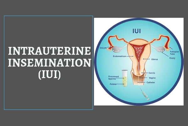 IUI- Intrauterine Insemination