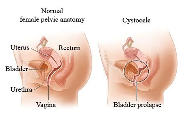 Bladder Prolapse