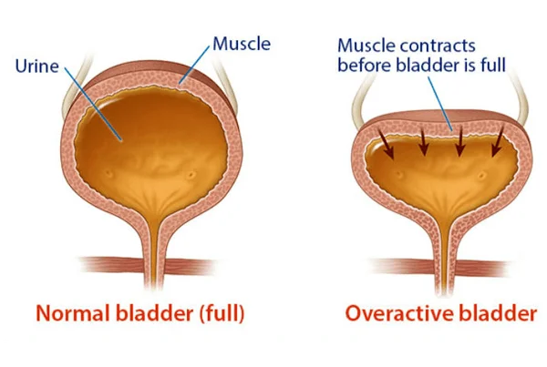 Overactive Bladder