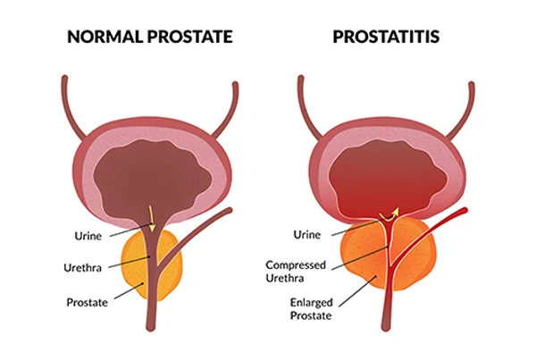 Prostatitis