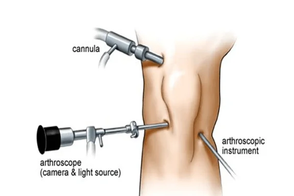 Arthroscopic