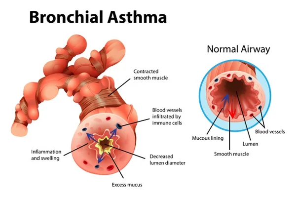 Bronchial Asthma