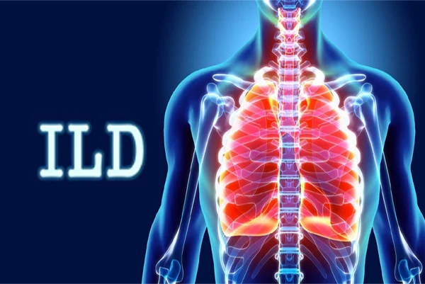 ILD