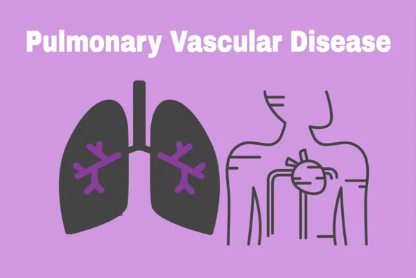 Pulmonary Sarcoidosis