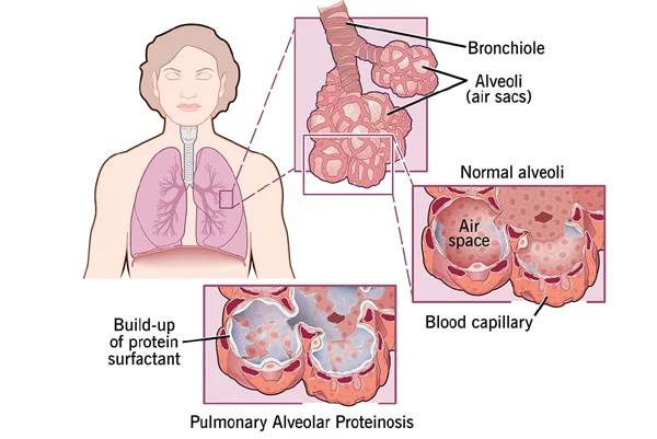 Alveolar Space Diseases