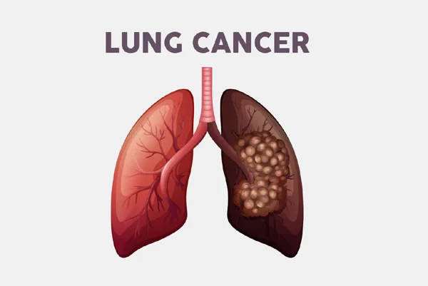 Lung Cancer