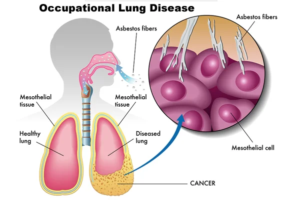 Occupational Lung Disease