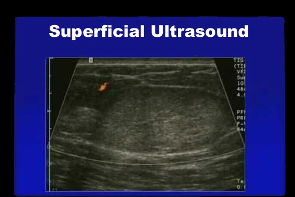 Superficial Ultrasound